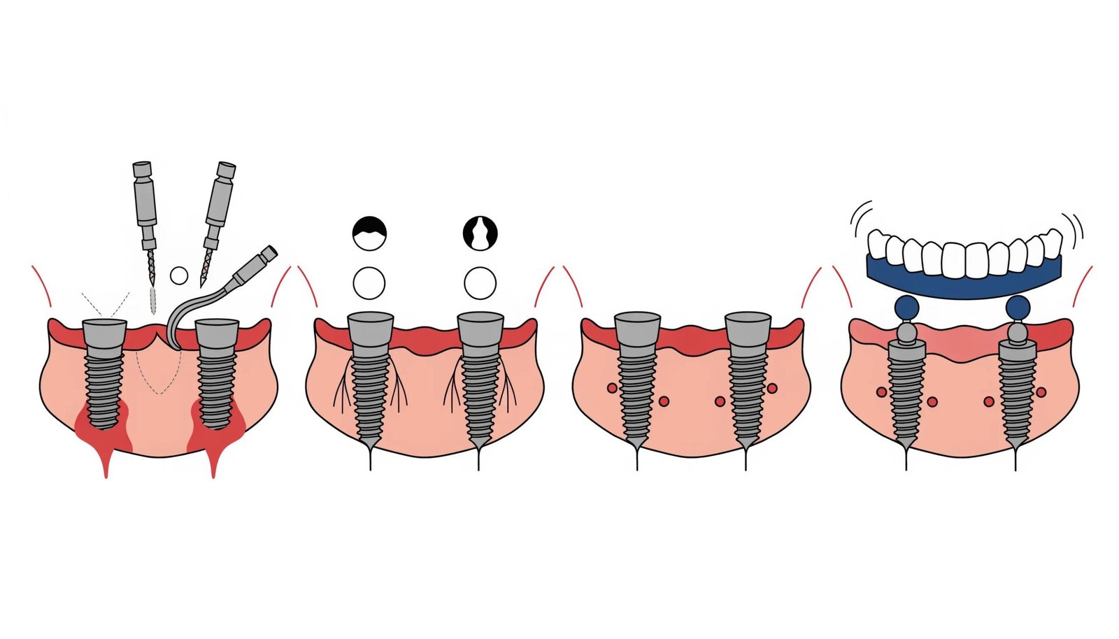 Diagram illustrating implant overdenture placement and stability with dental implants and abutments.
